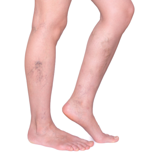 דליות / ורידים ברגליים – סיבות ודרכי הטיפול